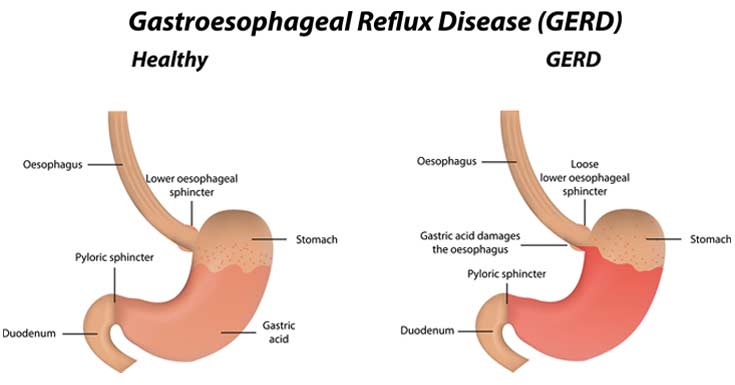 GASTRO INTESTINAL REFLUX DISEASE (GERD)